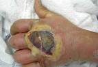 <b>Infection</b> of the hand caused