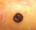 basocelular <b>pigmentado</b>