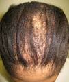 Early Cicatricial <b>Alopecia</b>