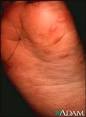 Hand, foot, and <b>mouth disease</b>