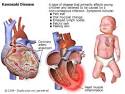 KAWASAKI DISEASE « Committed to early diagnosis and treatment of ...