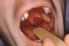 <b>reiter's syndrome</b> 5795 - RightDiagnosis.