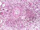 Hypertensive <b>Nephrosclerosis</b>
