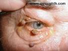 <b>papilloma</b>