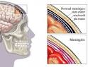 <b>Aseptic meningitis</b> occurs when