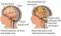 <b>Meningitis</b> (<b>viral</b> infection)