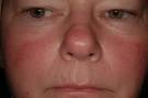 <b>Rosacea</b>