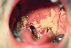 OPPORTUNISTIC <b>MYCOSES</b>