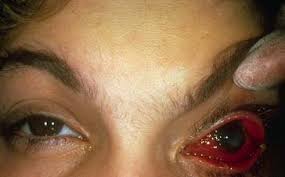 )Gonorrhea