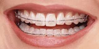 العادات الفموية السيئة وتأثيراتها على الأسنان  Ceramic_brackets