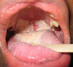 relief from a yeast infection