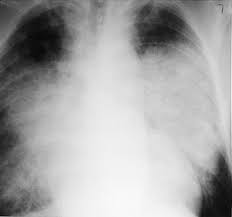 pulmonary congestion