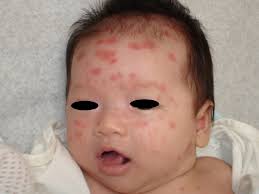 Neonatal lupus