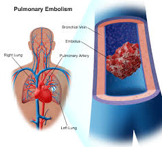 with Pulmonary Embolism