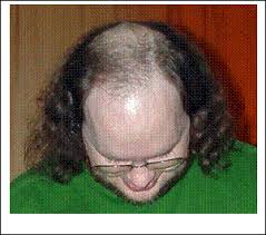 ریزش موی ارثی هورمونی androgenetic