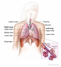 Mesothelioma: Facts about