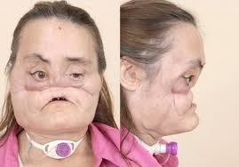 Face Transplant Patient,