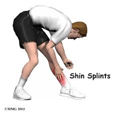 Posterior shin splints
