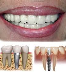 Qué son y cómo funcionan los implantes implante dental Qué son y cómo funcionan los implantes