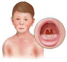 Symptoms of Scarlet Fever