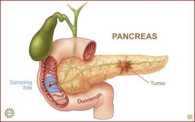 Human pancreas cancer cells