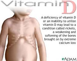 Vitamin D deficit