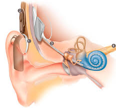 a cochlear implant can