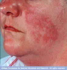 Lupus facial rash