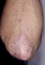 Plaque psoriasis on the elbow.