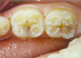 tooth enamel