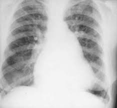 are pulmonary congestion,