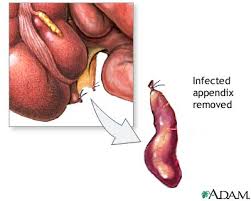 Appendectomy - series
