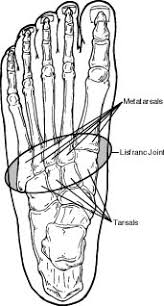 How Do Lisfranc Injuries Occur