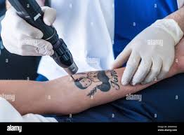 remove tattoo stock|676 Tattoo Removal Stock Photos, High-Res Pictures, and Images - Getty  Images | Laser tattoo removal, Tattoo, Tattoo regret