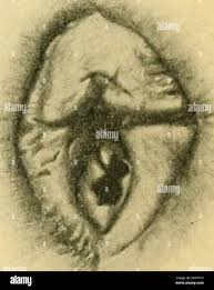 hymen child|Overview of Hymen: Know about Different Types of Hymens - Pristyn Care