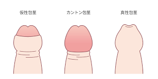 中学生包茎ちんこ|夏休み特集 お悩み解決!みんなの保健室「思春期男子の“シモ”の悩み」 - きょうの健康 - NHK