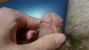 File uncircumcised and circumcised human wikimedia commons jpg 300x1280 Circumcised cock
