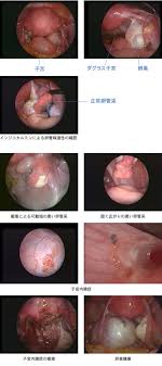 子宮口精子注射画像|教えて！】シリンジ法のやり方と人気シリンジキット比較 - 三軒茶屋Artクリニック