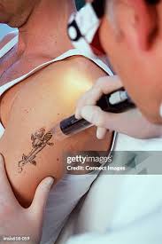 remove tattoo stock|Before and after laser tattoo removal on a man. Stock 写真 | Adobe Stock