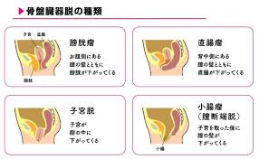 子宮脱|