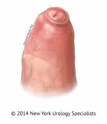 Отрезание пениса|💡 Обрезание или циркумцизио — это операция по удалению крайней плоти  головки полового члена. 🩺 Операцию обрезания делают как по медицинским  показаниям (фимоз, профилактика заболеваний, необходимость увеличить  продолжительность полового акта), так и