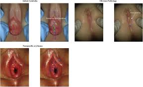 pedactric genital exam of child|Prepubescent Female Genital Examination Images: Evidence-Informed Learning  Opportunities - Journal of Pediatric and Adolescent Gynecology