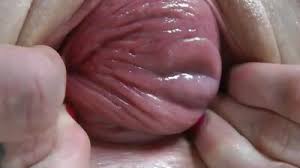 Perversefamilylive extreme vaginal prolapse jpg x Pussy prolapse