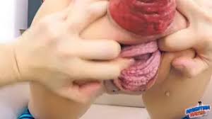 Extreme anal prolapse sex jpg x Extreme anal prolapse sex