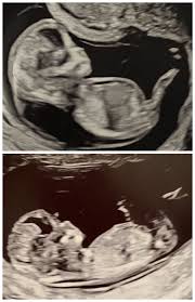 incest 3d pregnancy|Is it Time for Global Limits on Donor-Created (Half) Siblings? | PET