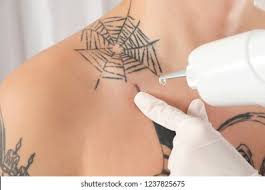 remove tattoo stock|482 Tattoo And Removal Stock Photos, High-Res Pictures, and Images - Getty  Images