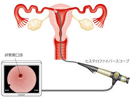 子宮口精子注射画像|5回分 妊活シリンジ シリンジ法 妊活 シリンジ タイミング法 妊活セット Mediken カテーテル チューブ 妊娠活動 自宅 膣内注入法 授精 :  TY Factory - 通販 - Yahoo!ショッピング