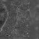 First-of-its-kind cataract surgery using stem cells shows promise 