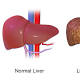 FDA Warns Against Hepatitis B Reactivation In Some Patients Taking Direct-Acting Hepatitis C Antivirals 