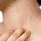 Psoriasis May Lead to Higher Risk of Obesity and Type 2 Diabetes 